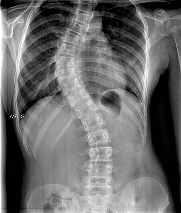 Képtalálat a következőre: „scoliosis x ray images”