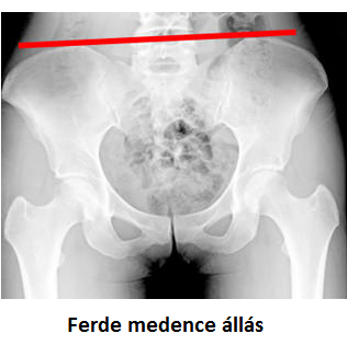 ízületi fájdalom csípő subluxáció a térd artrózisának kezelése 1 fok