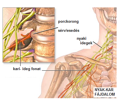 hátfájás a nyakban a lumbosacralis régió osteochondrosisa