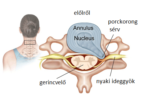 A nyaki gerinc kezelés nemcrovertebralis artrózisa