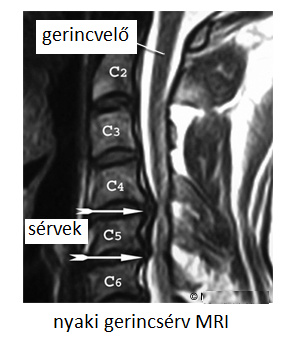 a nyaki régió osteochondrosisa nyaki osteochondrosis férfiaknál